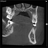 レントゲン写真