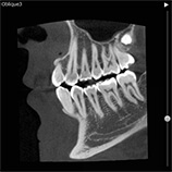 レントゲン写真