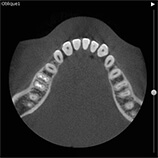 レントゲン写真